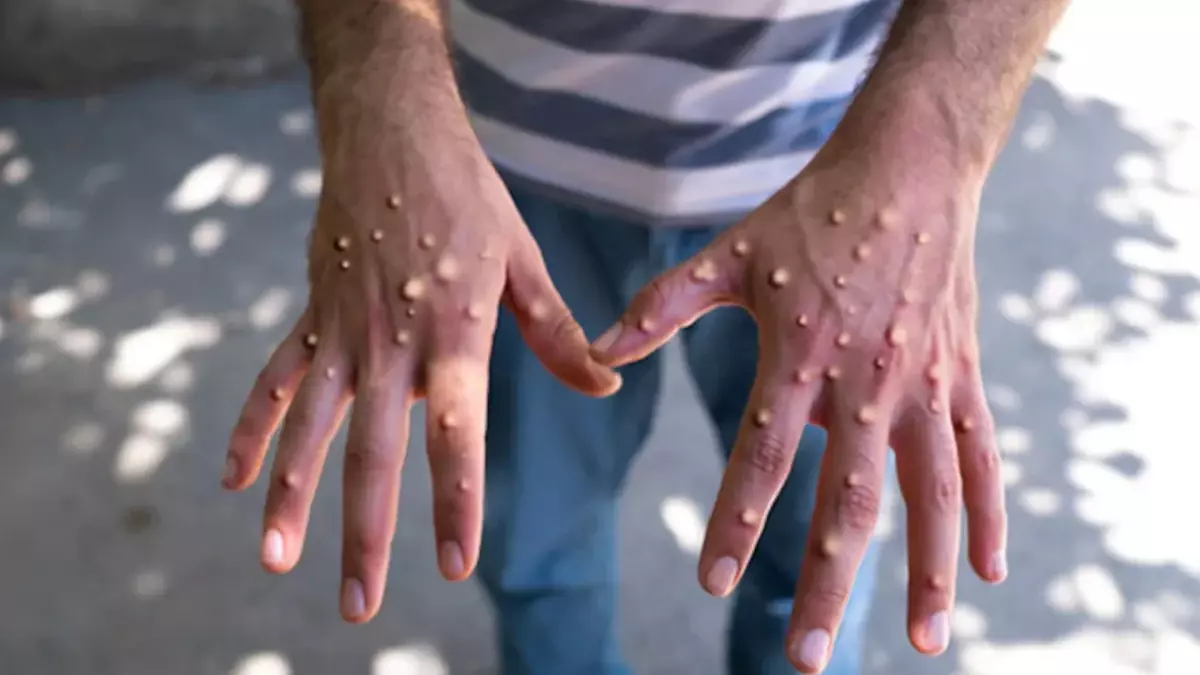 Pakistan’da Maymun Çiçeği Alarmı: 12 Günlük Kapanma İlan Edildi!