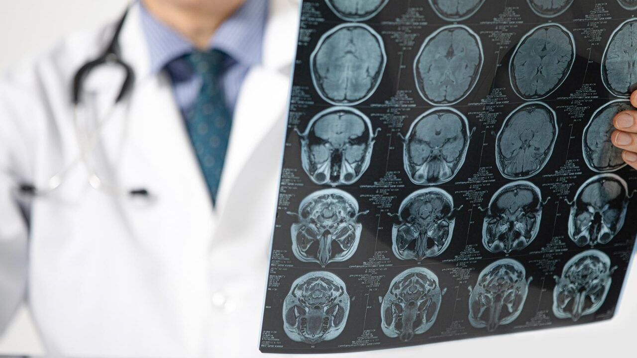 Genetik kodda gizli tehlike: Erkeklerde demans riski yükseliyor
