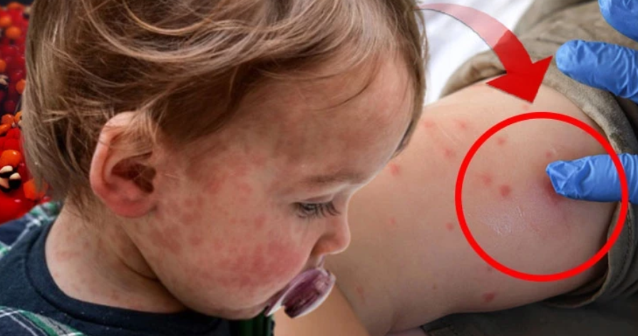 Kızamığın Sinsi Tehlikesi: SSPE Hastalığı Nedir?